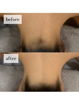 リライル(Lyraile)/うなじ脱毛