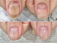 リファーレ(RIFARE)/【深爪矯正】凸凹爪が劇的変化！