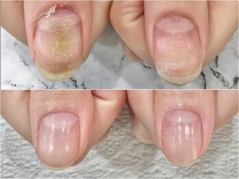 リファーレ(RIFARE)/【深爪矯正】凸凹爪が劇的変化!