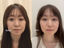 ストリ(STRI)/美容鍼　ビフォーアフター