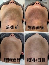 モエンド(MOEND)/ダウンタイムの参考