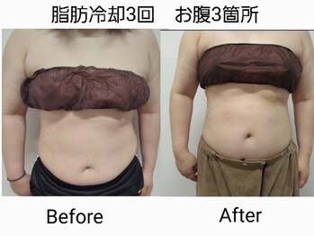 スリム(SLIM by lily of the valley)/お腹3回