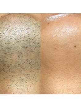 ボディデザイン ビィーラボ(BODY Design BE Labo)/メンズヒゲ脱毛は最新機器で