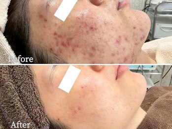 ニキビケア研究所 池袋店/お顔全体のニキビケア