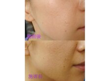 ビューティーフィール(Beauty Feel)の雰囲気（リベルハーブピーリングであらゆる肌悩み解消！見違えるお肌に！）
