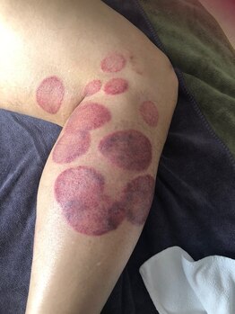 中国整体 らくらく堂/温熱療法吸い玉デトックス