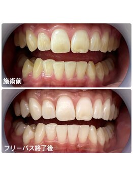ホワイトニングサロン 京都烏丸店/ホワイトニング施術例