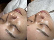 スパークル/フェイシャル/くすみ/毛穴