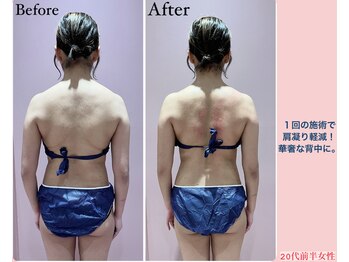 じぶんdeエステ 梅田店/CELLZERO.式 症例/背中/1回