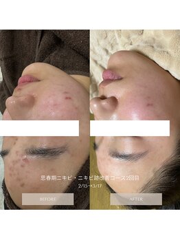 タグ 高知駅前店(Tug)/【思春期ニキビケア・跡】