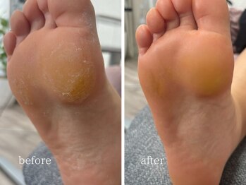 爪のいろは/フットケア　足裏　角質ケア