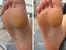 フットケア 足裏 角質ケア