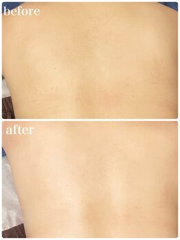 フルオール(FRUOR)/ブライダル背中ケア