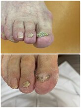 巻き爪じゅん 千葉駅前店/丁寧なケアで快適な足元に