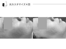 スパレーカ(Spa laka)/光カスタマイズ