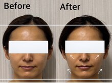 ベール(BEHL)/コルギのBefore After