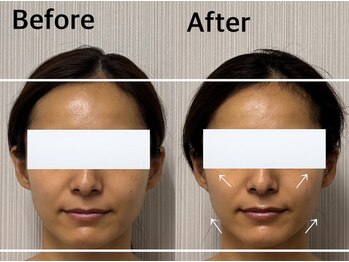 ベール(BEHL)/コルギのBefore After