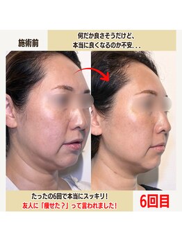 経堂鍼灸整体院/幹細胞美容鍼+小顔矯正