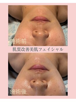 シンナリ(Shinnari)/肌質改善美肌フェイシャル