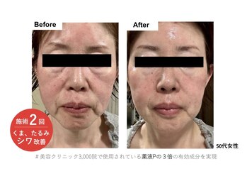 パタティパタタ(PatatiPatata)/医師監修のヒト幹細胞培養液