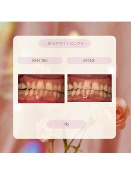 プラスビーセルフ(+b self)/ホワイトニングビフォーアフター