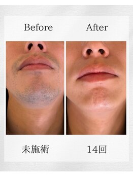 スキンスタジオトウキョウ(SKIN STUDIO TOKYO)/ヒゲ脱毛14回