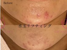 サロンヴェアリー 広尾(salon vary)/水玉リフティング　