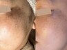 【シミ・モヤモヤ色むら】プラズマ×超音波で広範囲に広がる色むら改善！
