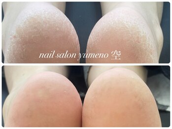 かかと角質ケア