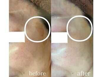 ブランシェ 金沢店 × 椿/シミケア　『50代お客様』