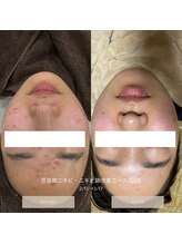 タグ 高知駅前店(Tug)/【思春期ニキビケア・跡】