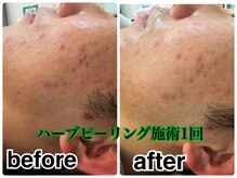 デューン 蕨店(Dune)/ハーブピーリング