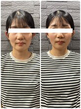 長寿鍼灸院 長寿整骨院/ハリネズミ女優美容鍼効果★