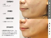 ルディラ 渋谷店/小顔バイオリフト