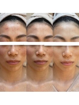 ボニータ(Bonita)/ヒト羊膜臍帯幹細胞エステ