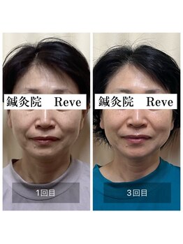 わきさか鍼灸整骨院・鍼灸院 レーヴ(Reve)/3回でこの変化♪