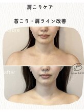 インディバ ベース(INDIBA BASE)/肩こり改善