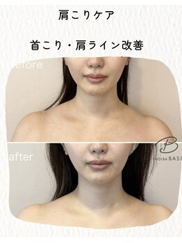 インディバ ベース(INDIBA BASE)/肩こり改善