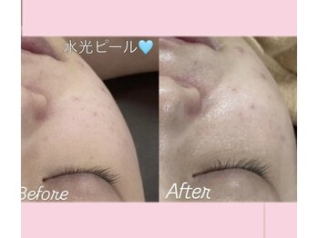 エステティック　レイビス 渋谷店(RAYVIS)/新メニュー！水光ピール！