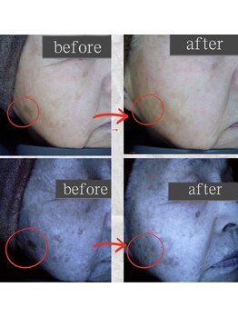 ポレポレ 八尾(polepole.)/79歳　シミ改善4ヶ月