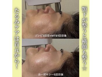 ハニエル(Haniel)/カーボキシー症例