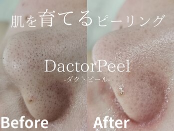 メイプル(Maple)の写真/月に1回の積み重ねが肌を変える!ララピール最新版【ダクトピール】が愛媛県最安値で受けられるサロン♪