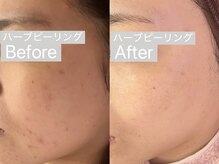 リンダ 西宮店(LINDA)の雰囲気（敏感肌の方も！剥離なしハーブピーリングでニキビ改善♪）