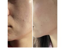 トゥモロー(TOMORROW)/ハーブピーリング/肌質改善