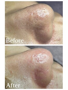 ジェンヌ(jenne.)/毛穴エクストラクション