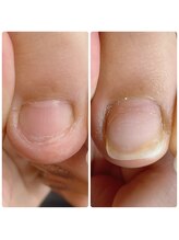 スマイルニコ(smile nico)/足の深爪矯正