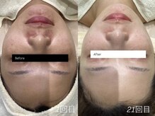 リンフェイス 銀座店(RIN FACE)の雰囲気（【本気で肌荒れ改善】剥離なしハーブピーリング&ヒト乳歯幹細胞）