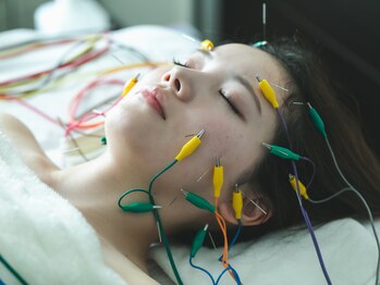 ハリスト(HARIST)の写真/《鍼電通で不調を根本改善◎》美容鍼で表情が明るく、目元もパッチリ★ストレスの緩和やカラダの不調に◎