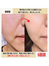 経堂鍼灸整体院/幹細胞美容鍼＋小顔矯正