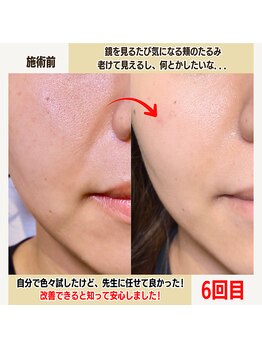 経堂鍼灸整体院/幹細胞美容鍼+小顔矯正